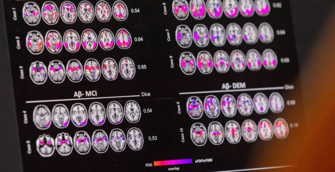 Mudança de hábitos pode reduzir risco de Alzheimer, mesmo com predisposição genética