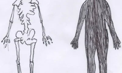 Anorexia e Bulimia: Casos Mundiais Disparam 71% em Duas Décadas
