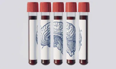 Exame de Sangue Revolucionário Promete Prever Alzheimer Décadas Antes, Mas Médicos Pedem Cautela