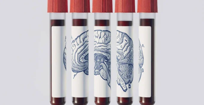 Exame de Sangue Revolucionário Promete Prever Alzheimer Décadas Antes, Mas Médicos Pedem Cautela