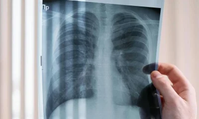 Estudo revela que pacientes com câncer de pulmão ALK positivo vivem menos no SUS