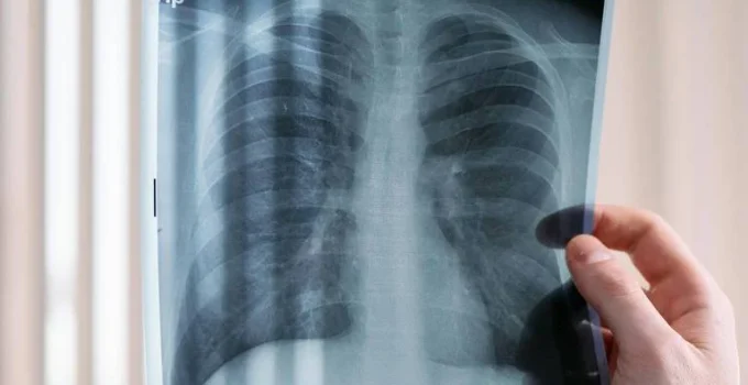 Estudo revela que pacientes com câncer de pulmão ALK positivo vivem menos no SUS