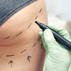 O lado sombrio do 'boom' de lifting de bumbum brasileiro no Reino Unido