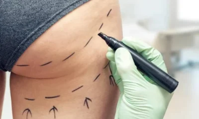 O lado sombrio do 'boom' de lifting de bumbum brasileiro no Reino Unido