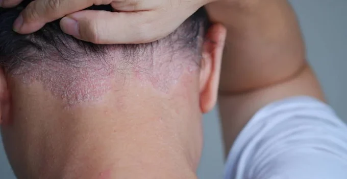 Inverno Agrava Doenças de Pele: Dermatite, Caspa e Psoríase Pedem Atenção Extra Inverno Agrava Doenças de Pele: Dermatite, Caspa e Psoríase Pedem Atenção Extra