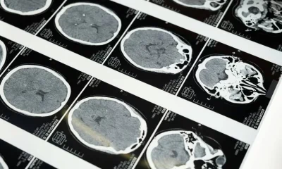 Anvisa aprova novos tratamentos para lúpus e esclerose múltipla em crianças e adolescentes