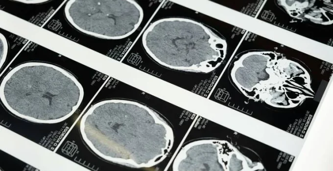 Anvisa aprova novos tratamentos para lúpus e esclerose múltipla em crianças e adolescentes