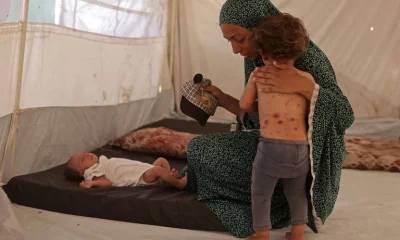 Catapora se espalha em acampamentos superlotados de Gaza, expondo crise humanitária