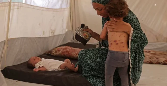 Catapora se espalha em acampamentos superlotados de Gaza, expondo crise humanitária
