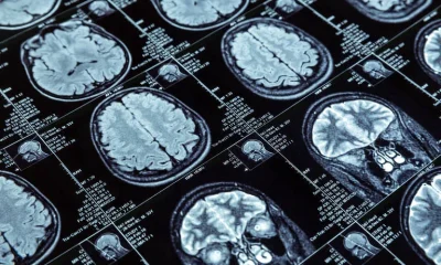 Consumo de açúcar na primeira infância pode elevar risco de demência na velhice, sugere estudo