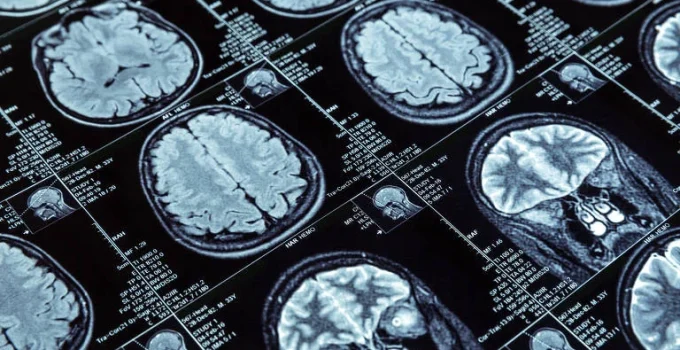 Consumo de açúcar na primeira infância pode elevar risco de demência na velhice, sugere estudo Consumo de açúcar na primeira infância pode elevar risco de demência na velhice, sugere estudo