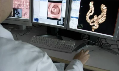 SUS adota teste mais preciso para rastreamento de câncer colorretal