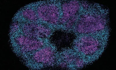 Avanço em Proteínas Cerebrais Abre Caminho para Novas Terapias Contra o Autismo