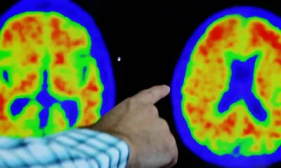 Exames de sangue para Alzheimer: testes de até R$ 5.000 chegam ao Brasil para auxiliar diagnóstico