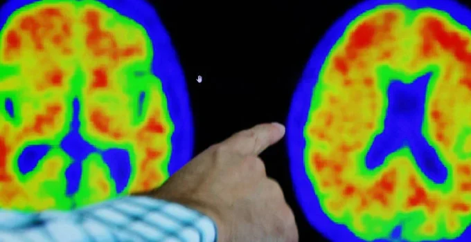 Exames de sangue para Alzheimer: testes de até R$ 5.000 chegam ao Brasil para auxiliar diagnóstico