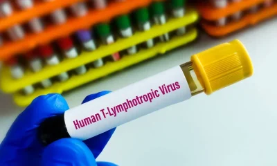 Vírus HTLV-1 pode causar síndrome inflamatória em portadores assintomáticos, aponta estudo
