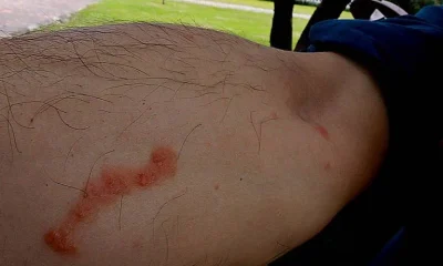 Escola em Lagoa Santa suspende aulas após surto de sarna