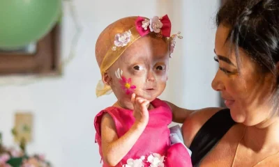 Morre Elis, uma das gêmeas diagnosticadas com progéria, doença rara de envelhecimento precoce