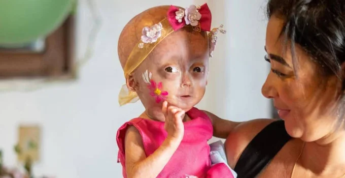 Morre Elis, uma das gêmeas diagnosticadas com progéria, doença rara de envelhecimento precoce