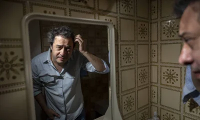 Seis meses após transplante capilar, jornalista relata foliculite e melhora incompleta